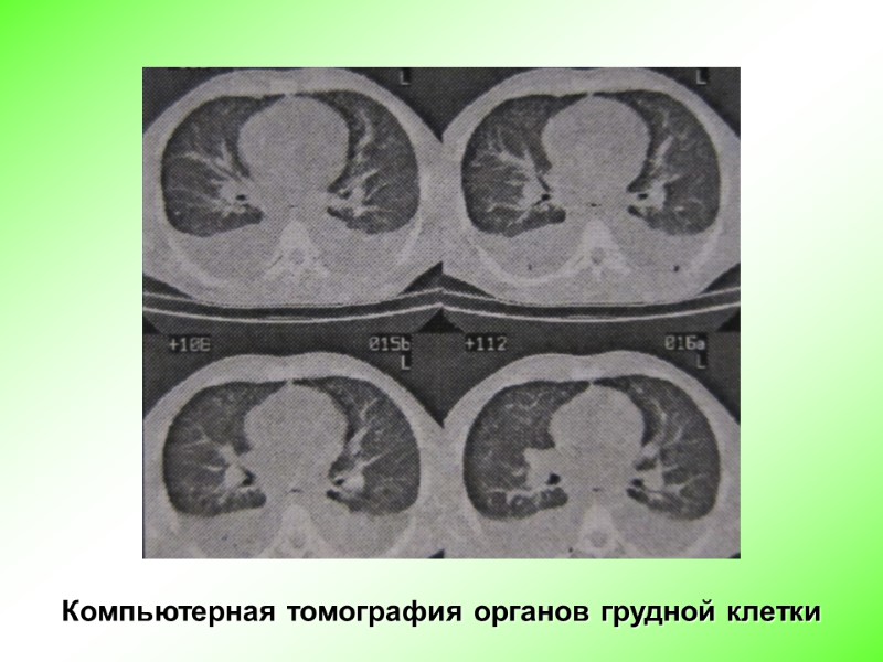 Компьютерная томография органов грудной клетки